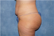 Tummy Tuck Before Photo by George John Alexander, MD, FACS; ,  - Case 44519