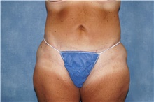 Tummy Tuck After Photo by George John Alexander, MD, FACS; Las Vegas, NV - Case 44520