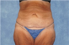 Tummy Tuck Before Photo by George John Alexander, MD, FACS; ,  - Case 44520