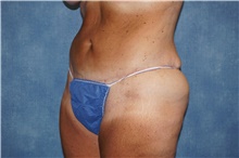 Tummy Tuck After Photo by George John Alexander, MD, FACS; ,  - Case 44520