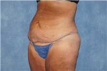 Tummy Tuck Before Photo by George John Alexander, MD, FACS; ,  - Case 44520