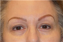 Eyelid Surgery After Photo by George John Alexander, MD, FACS; Las Vegas, NV - Case 44521