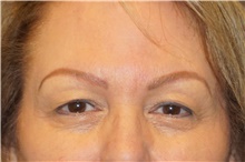 Eyelid Surgery Before Photo by George John Alexander, MD, FACS; Las Vegas, NV - Case 44521