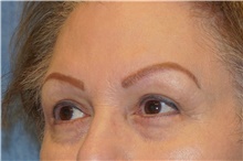 Eyelid Surgery After Photo by George John Alexander, MD, FACS; ,  - Case 44521