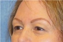 Eyelid Surgery Before Photo by George John Alexander, MD, FACS; ,  - Case 44521
