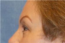 Eyelid Surgery After Photo by George John Alexander, MD, FACS; ,  - Case 44521