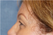 Eyelid Surgery Before Photo by George John Alexander, MD, FACS; ,  - Case 44521