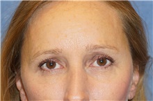 Eyelid Surgery After Photo by George John Alexander, MD, FACS; Las Vegas, NV - Case 44525