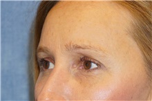 Eyelid Surgery After Photo by George John Alexander, MD, FACS; ,  - Case 44525
