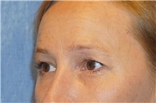 Eyelid Surgery Before Photo by George John Alexander, MD, FACS; ,  - Case 44525