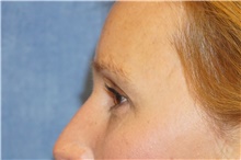 Eyelid Surgery After Photo by George John Alexander, MD, FACS; ,  - Case 44525