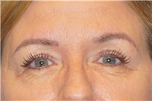 Eyelid Surgery After Photo by George John Alexander, MD, FACS; ,  - Case 44526