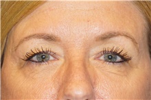 Eyelid Surgery Before Photo by George John Alexander, MD, FACS; ,  - Case 44526