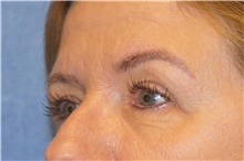 Eyelid Surgery After Photo by George John Alexander, MD, FACS; ,  - Case 44526