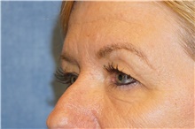 Eyelid Surgery Before Photo by George John Alexander, MD, FACS; ,  - Case 44526
