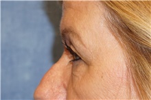 Eyelid Surgery Before Photo by George John Alexander, MD, FACS; ,  - Case 44526