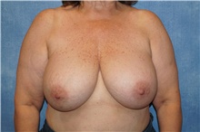 Breast Implant Removal Before Photo by George John Alexander, MD, FACS; Las Vegas, NV - Case 44769
