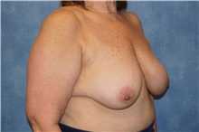 Breast Implant Removal After Photo by George John Alexander, MD, FACS; ,  - Case 44769