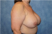Breast Implant Removal Before Photo by George John Alexander, MD, FACS; ,  - Case 44769