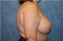 Breast Implant Removal Before Photo by George John Alexander, MD, FACS; ,  - Case 44769