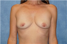 Breast Implant Removal After Photo by George John Alexander, MD, FACS; Las Vegas, NV - Case 44770