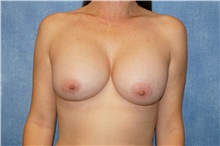 Breast Implant Removal Before Photo by George John Alexander, MD, FACS; Las Vegas, NV - Case 44770