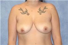 Breast Implant Removal After Photo by George John Alexander, MD, FACS; Las Vegas, NV - Case 44772