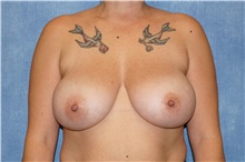 Breast Implant Removal Before Photo by George John Alexander, MD, FACS; Las Vegas, NV - Case 44772