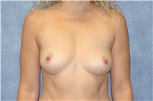 Breast Implant Removal After Photo by George John Alexander, MD, FACS; Las Vegas, NV - Case 44773
