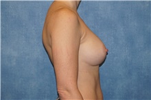 Breast Implant Removal Before Photo by George John Alexander, MD, FACS; Las Vegas, NV - Case 44773