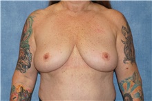 Breast Implant Removal After Photo by George John Alexander, MD, FACS; ,  - Case 44774