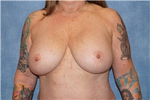 Breast Implant Removal Before Photo by George John Alexander, MD, FACS; ,  - Case 44774