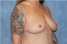 Breast Implant Removal After Photo by George John Alexander, MD, FACS; ,  - Case 44774