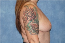 Breast Implant Removal After Photo by George John Alexander, MD, FACS; ,  - Case 44774