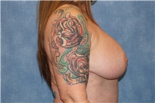 Breast Implant Removal Before Photo by George John Alexander, MD, FACS; ,  - Case 44774