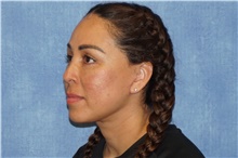 Facelift After Photo by George John Alexander, MD, FACS; ,  - Case 46246