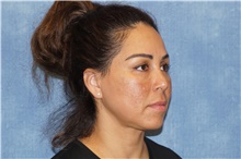 Facelift Before Photo by George John Alexander, MD, FACS; ,  - Case 46246