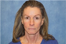 Facelift After Photo by George John Alexander, MD, FACS; Las Vegas, NV - Case 46249