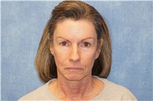 Facelift Before Photo by George John Alexander, MD, FACS; Las Vegas, NV - Case 46249