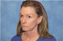 Facelift After Photo by George John Alexander, MD, FACS; Las Vegas, NV - Case 46249