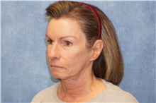 Facelift Before Photo by George John Alexander, MD, FACS; Las Vegas, NV - Case 46249