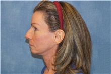 Facelift After Photo by George John Alexander, MD, FACS; Las Vegas, NV - Case 46249