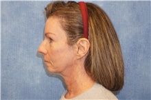 Facelift Before Photo by George John Alexander, MD, FACS; Las Vegas, NV - Case 46249