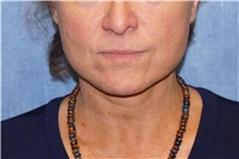 Facelift After Photo by George John Alexander, MD, FACS; ,  - Case 46250