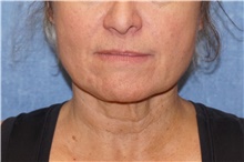 Facelift Before Photo by George John Alexander, MD, FACS; ,  - Case 46250