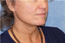 Facelift After Photo by George John Alexander, MD, FACS; ,  - Case 46250