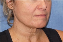 Facelift Before Photo by George John Alexander, MD, FACS; ,  - Case 46250