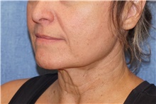 Facelift Before Photo by George John Alexander, MD, FACS; ,  - Case 46250