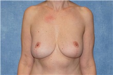 Breast Reduction After Photo by George John Alexander, MD, FACS; Las Vegas, NV - Case 46253