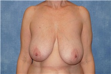 Breast Reduction Before Photo by George John Alexander, MD, FACS; Las Vegas, NV - Case 46253